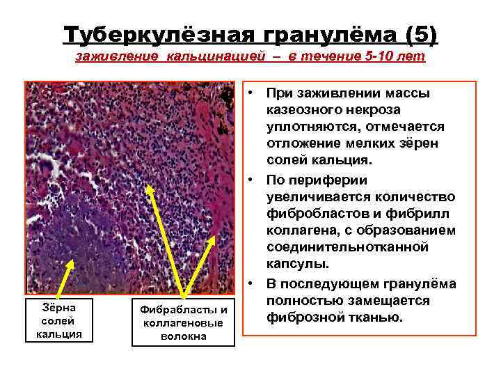 Туберкулёзная гранулёма (5) заживление кальцинацией – в течение 5 -10 лет Туберкулёзная гранулёма (5) заживление кальцинацией – в течение 5 -10 лет