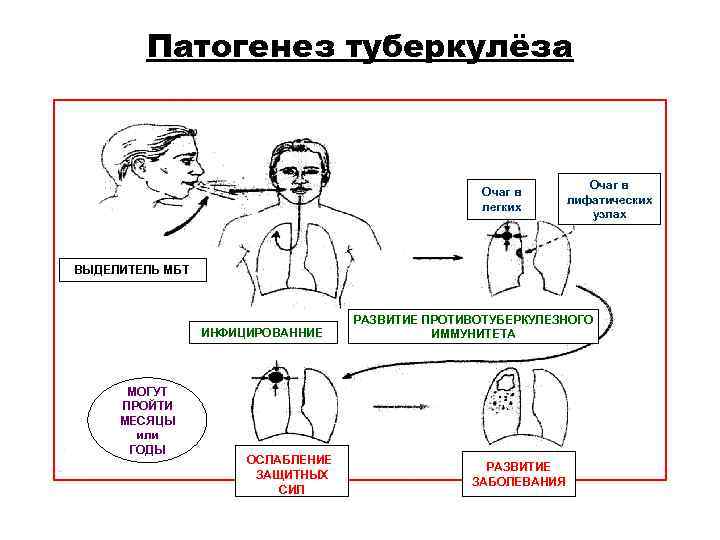 Патогенез туберкулёза Очаг в Патогенез туберкулёза Очаг в