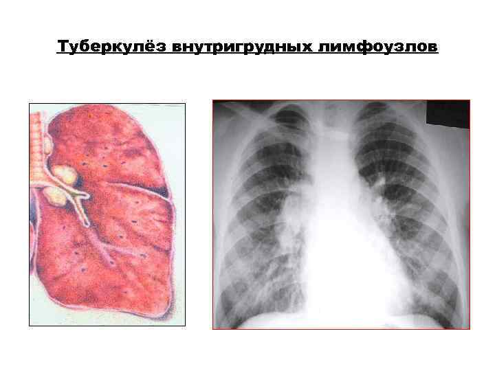 Туберкулёз внутригрудных лимфоузлов Туберкулёз внутригрудных лимфоузлов