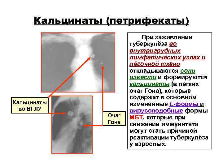Кальцинаты (петрифекаты) При заживлении туберкулёза Кальцинаты (петрифекаты) При заживлении туберкулёза