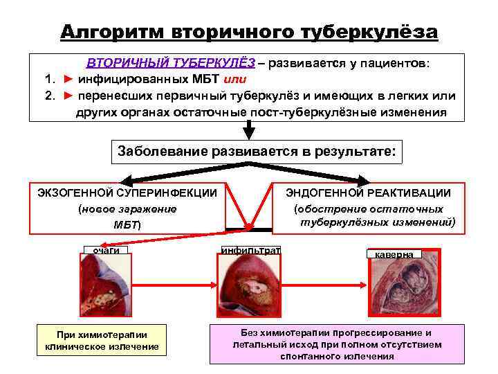 Алгоритм вторичного туберкулёза ВТОРИЧНЫЙ ТУБЕРКУЛЁЗ – развивается у пациентов: 1. Алгоритм вторичного туберкулёза ВТОРИЧНЫЙ ТУБЕРКУЛЁЗ – развивается у пациентов: 1.