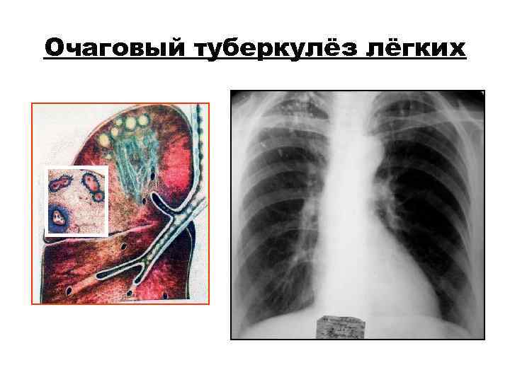 Очаговый туберкулёз лёгких Очаговый туберкулёз лёгких