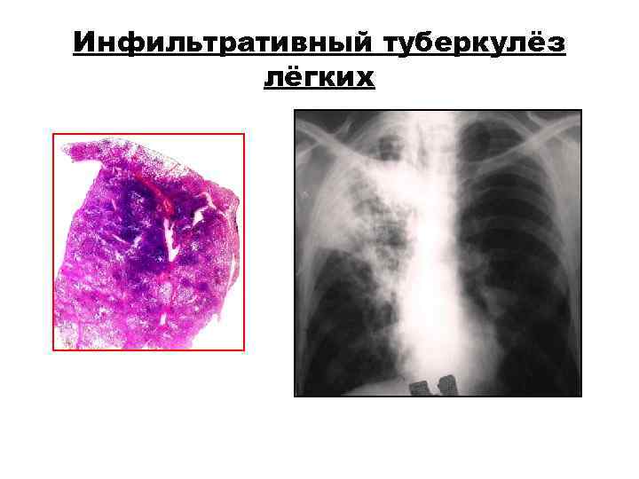 Инфильтративный туберкулёз лёгких Инфильтративный туберкулёз лёгких