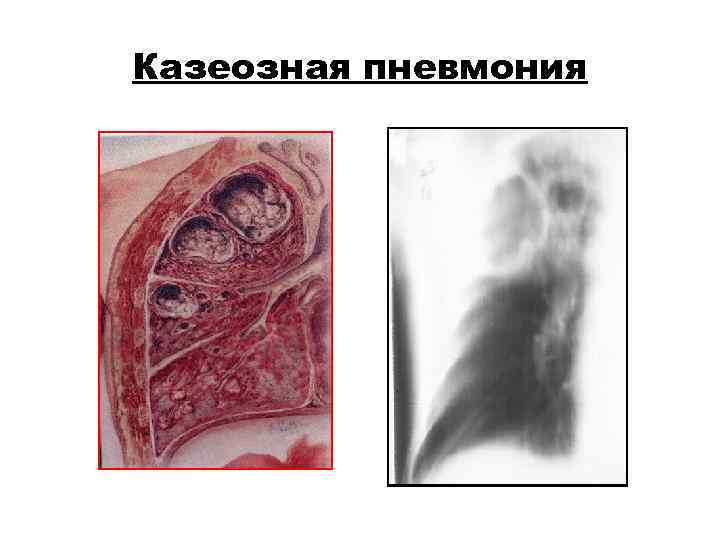 Казеозная пневмония Казеозная пневмония