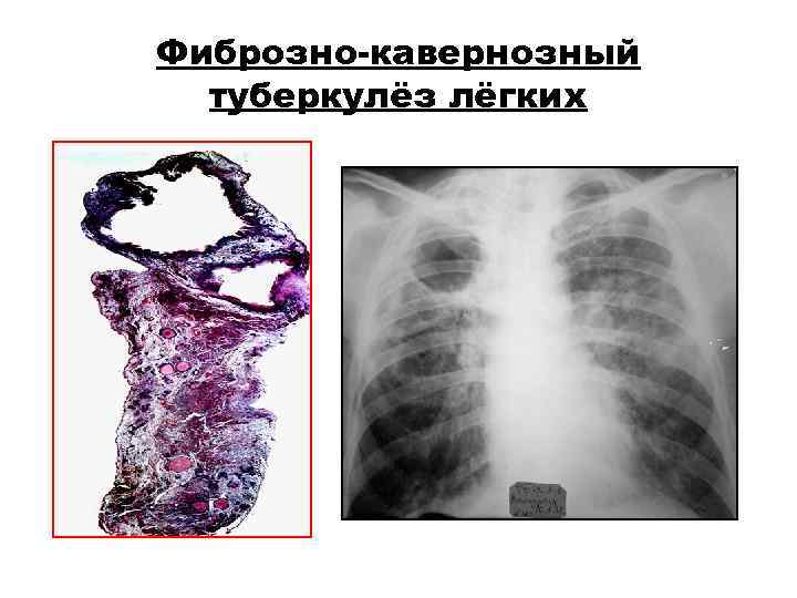 Фиброзно-кавернозный туберкулёз лёгких Фиброзно-кавернозный туберкулёз лёгких