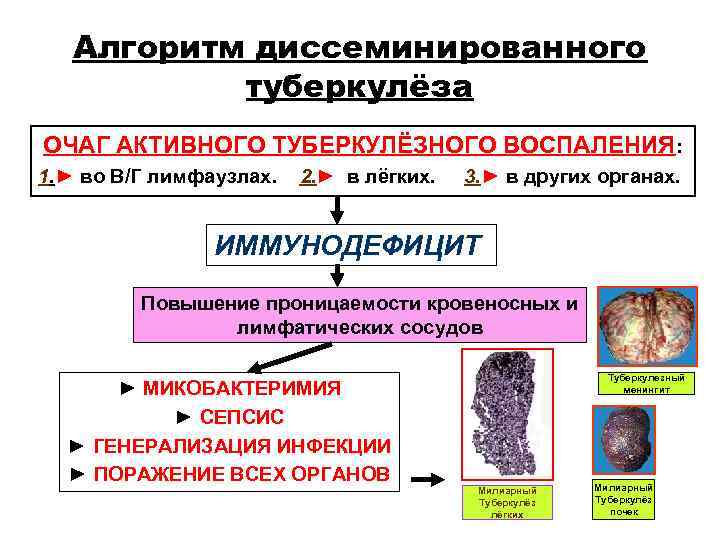 Алгоритм диссеминированного туберкулёза ОЧАГ АКТИВНОГО ТУБЕРКУЛЁЗНОГО ВОСПАЛЕНИЯ: 1. ► во В/Г Алгоритм диссеминированного туберкулёза ОЧАГ АКТИВНОГО ТУБЕРКУЛЁЗНОГО ВОСПАЛЕНИЯ: 1. ► во В/Г