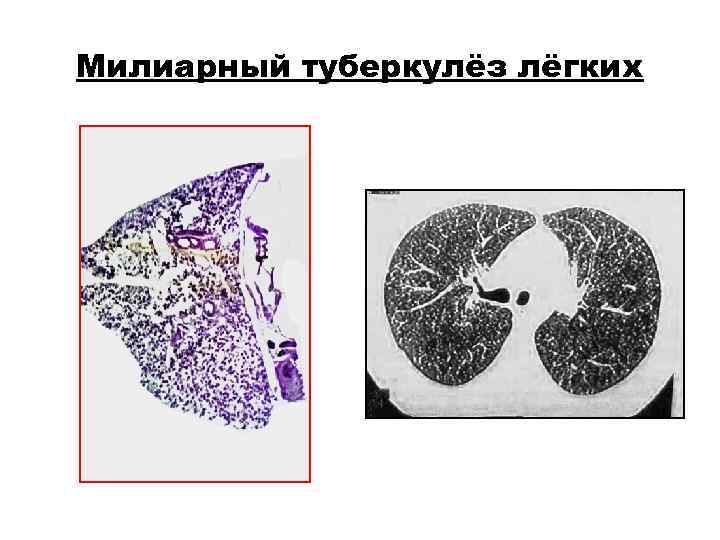 Милиарный туберкулёз лёгких Милиарный туберкулёз лёгких