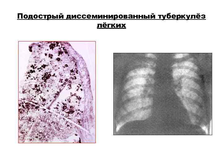 Подострый диссеминированный туберкулёз лёгких Подострый диссеминированный туберкулёз лёгких