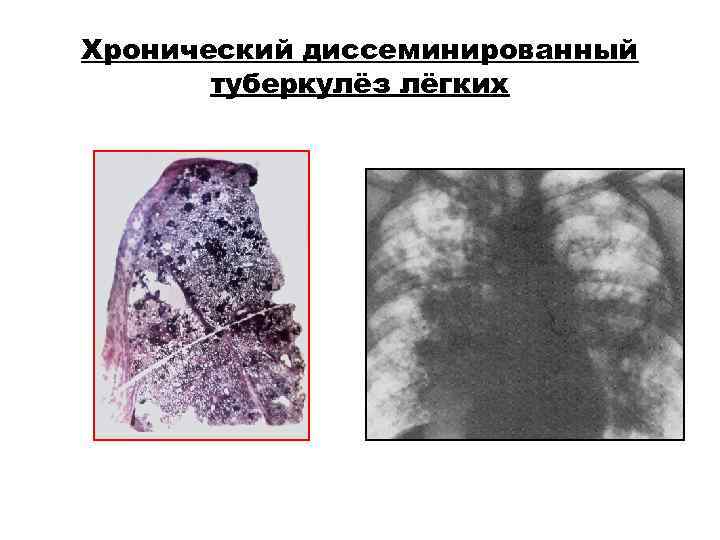 Хронический диссеминированный туберкулёз лёгких Хронический диссеминированный туберкулёз лёгких