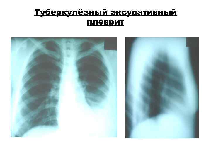 Туберкулёзный эксудативный плеврит Туберкулёзный эксудативный плеврит