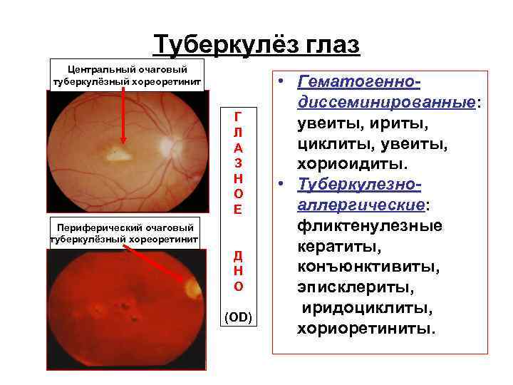 Туберкулёз глаз Центральный очаговый туберкулёзный хореоретинит • Гематогенно- Туберкулёз глаз Центральный очаговый туберкулёзный хореоретинит • Гематогенно-