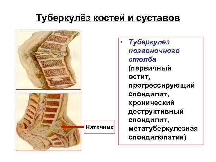 Туберкулёз костей и суставов • Туберкулез Туберкулёз костей и суставов • Туберкулез
