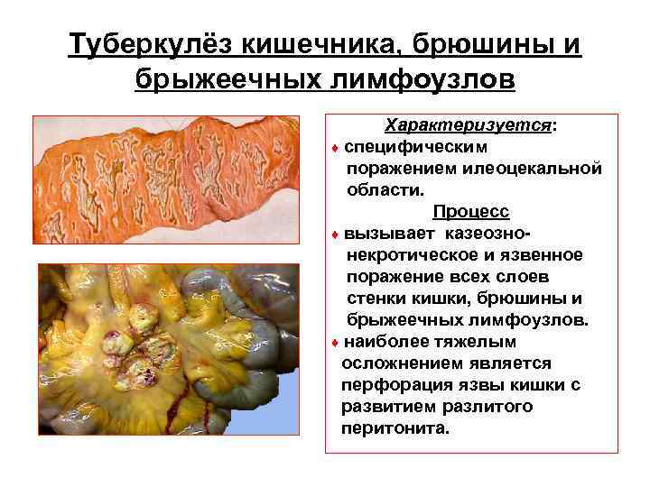 Туберкулёз кишечника, брюшины и брыжеечных лимфоузлов Характеризуется: ♦ Туберкулёз кишечника, брюшины и брыжеечных лимфоузлов Характеризуется: ♦