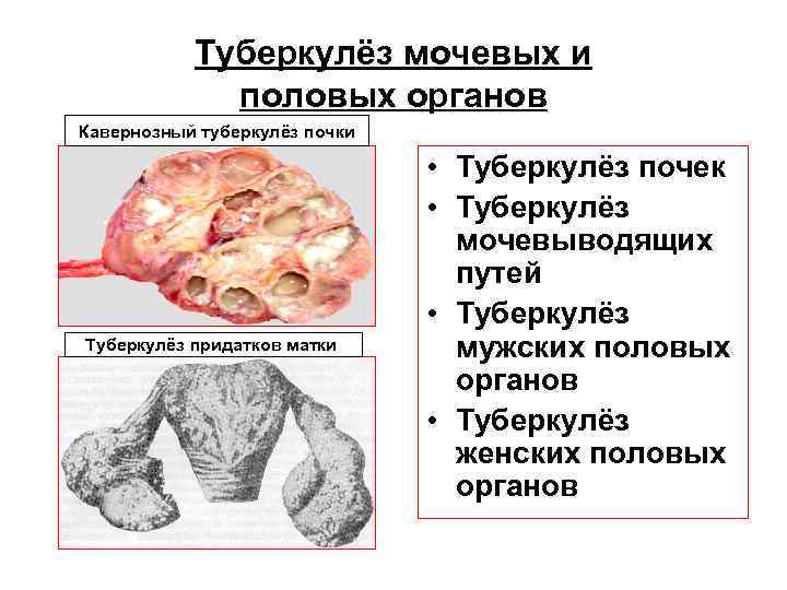 Туберкулёз мочевых и половых органов Кавернозный туберкулёз почки Туберкулёз мочевых и половых органов Кавернозный туберкулёз почки