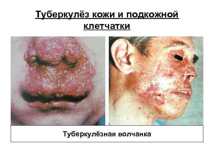 Туберкулёз кожи и подкожной клетчатки Туберкулёзная волчанка Туберкулёз кожи и подкожной клетчатки Туберкулёзная волчанка
