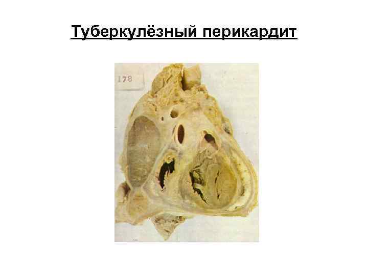 Туберкулёзный перикардит Туберкулёзный перикардит