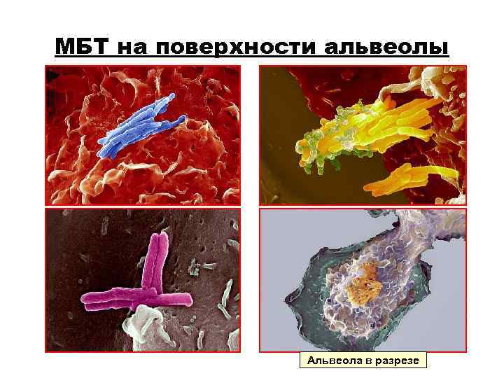 МБТ на поверхности альвеолы Альвеола в разрезе МБТ на поверхности альвеолы Альвеола в разрезе
