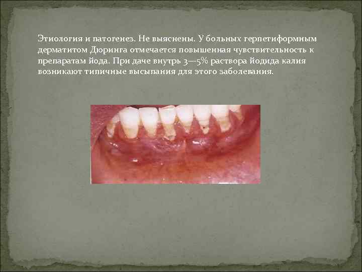 Этиология и патогенез. Не выяснены. У больных герпетиформным дерматитом Дюринга отмечается повышенная чувствительность к