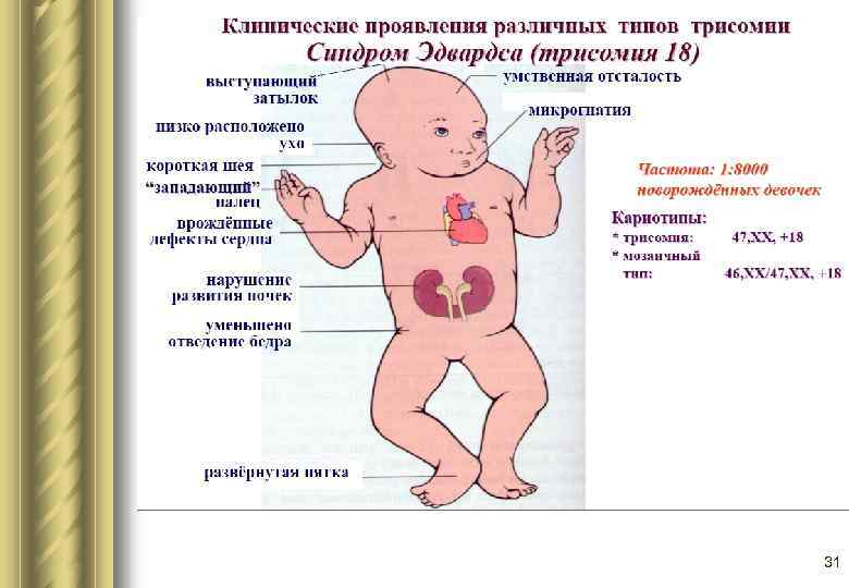 18 хромосома