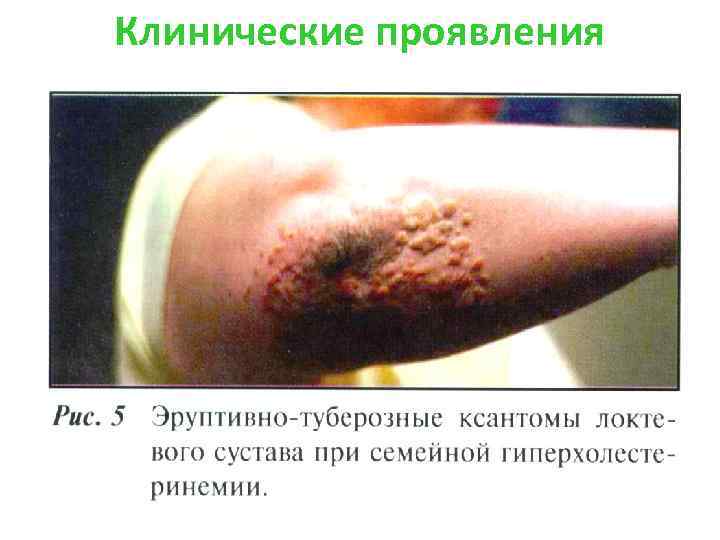 Клинические проявления 