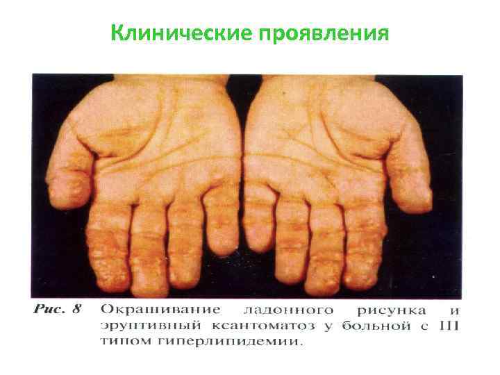 Клинические проявления 