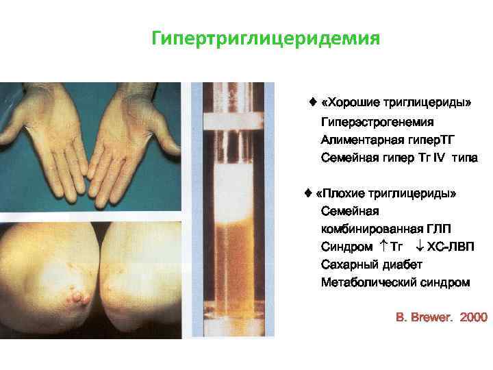 Гипертриглицеридемия ♦ «Хорошие триглицериды» Гиперэстрогенемия Алиментарная гипер. ТГ Семейная гипер Тг IV типа ♦