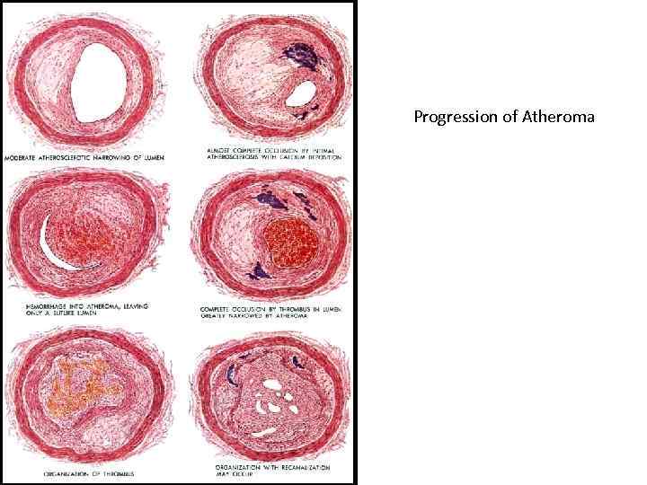 Progression of Atheroma 