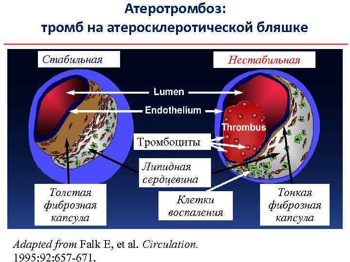 Атеротромбоз: тромб на атеросклеротической бляшке Стабильная Нестабильная Тромбоциты Липидная сердцевина Толстая фиброзная капсула Клетки