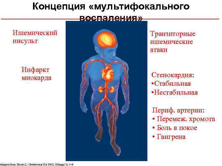 Концепция «мультифокального воспаления» Ишемический инсульт Инфаркт миокарда Adapted from: Drouet L. Cerebrovasc Dis 2002;