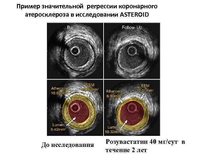 Атеросклероз обследование. Исследование астероид розувастатин. Регрессия атеросклеротических бляшек. ВСУЗИ коронарных артерий. Внутрисосудистый ультразвук коронарных артерий.