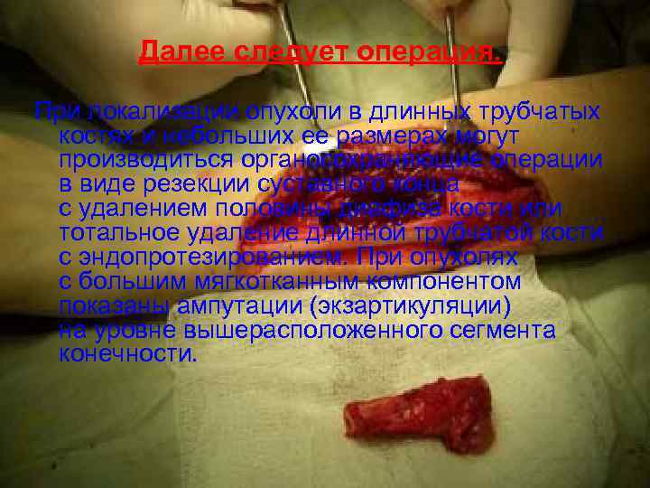   Далее следует операция.  При локализации опухоли в длинных трубчатых  костях