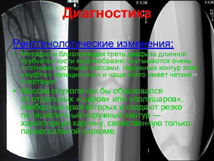    Диагностика Рентгенологические изменения:  • Метафиз и близлежащая треть диафиза длинной