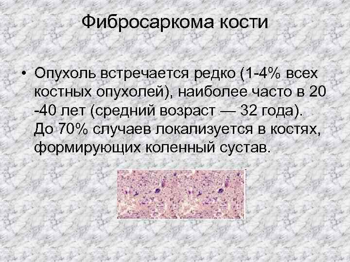  Фибросаркома кости  • Опухоль встречается редко (1 -4% всех  костных