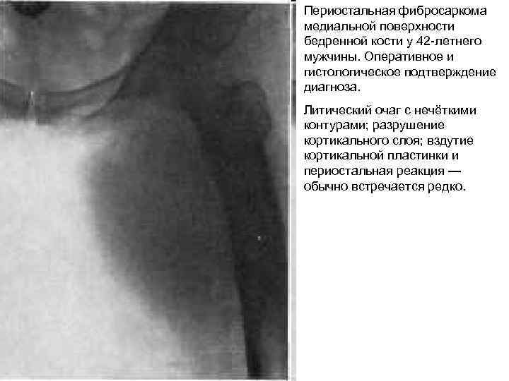 Периостальная фибросаркома медиальной поверхности бедренной кости у 42 -летнего мужчины. Оперативное и гистологическое подтверждение
