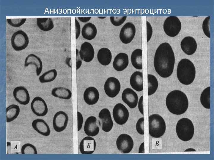 Анизоцитоз микро незначительный