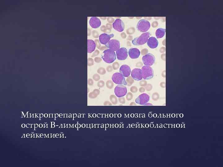 Микропрепарат костного мозга больного острой В-лимфоцитарной лейкобластной лейкемией. 