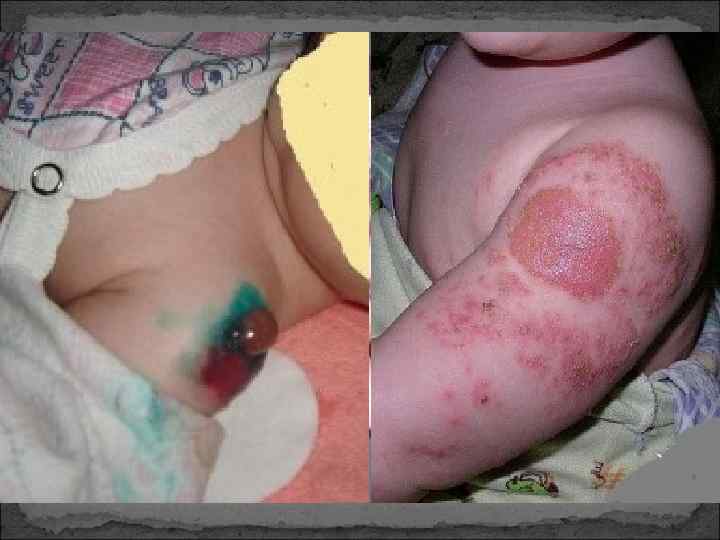    Особенности клинического течения   туберкулеза у ВИЧ-инфицированных  v. Интоксикационный