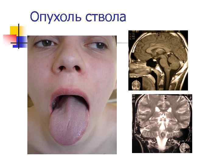 Опухоль ствола 