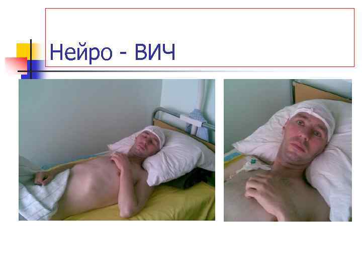 Нейро ВИЧ 