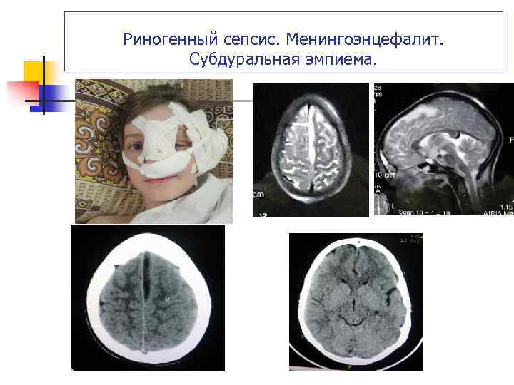 Риногенный сепсис. Менингоэнцефалит. Субдуральная эмпиема. 