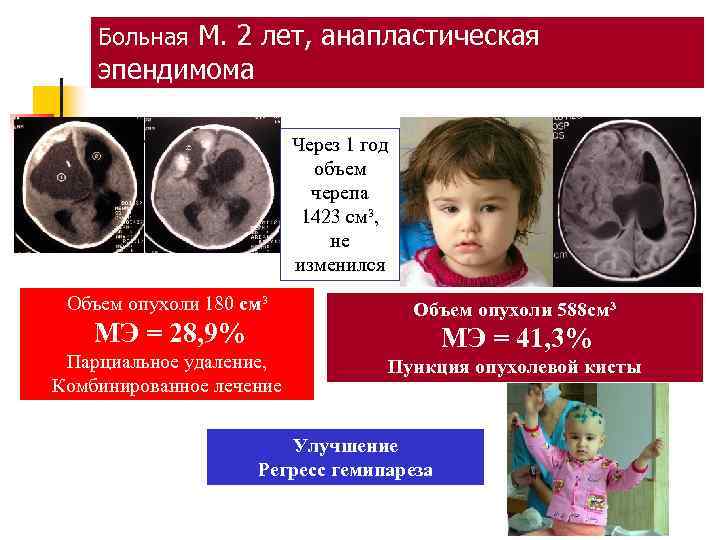 Больная М. 2 лет, анапластическая эпендимома Через 1 год объем черепа 1423 см³, не