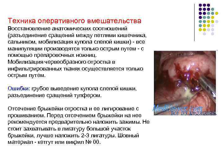 Техника оперативного вмешательства Восстановление анатомических соотношений (разъединение сращений между петлями кишечника, сальником, мобилизация купола