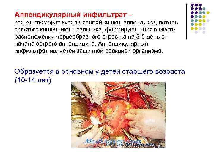 Аппендикулярный инфильтрат – это конгломерат купола слепой кишки, аппендикса, петель толстого кишечника и сальника,