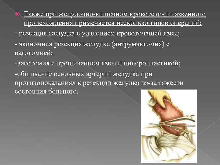  Также при желудочно-кишечном кровотечении язвенного происхождения применяется несколько типов операций: - резекция
