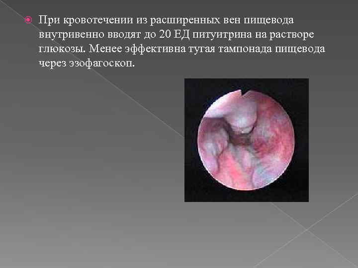   При кровотечении из расширенных вен пищевода внутривенно вводят до 20 ЕД питуитрина