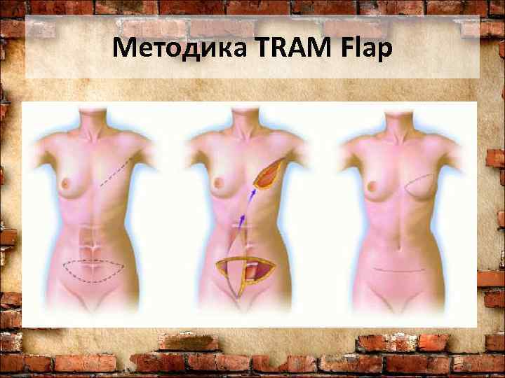 Методика TRAM Flap 