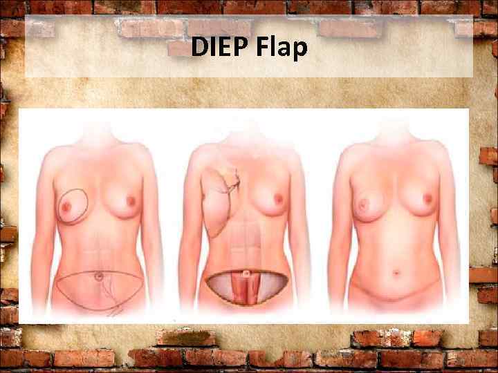 DIEP Flap 