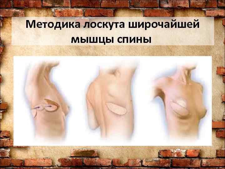 Методика лоскута широчайшей  мышцы спины 