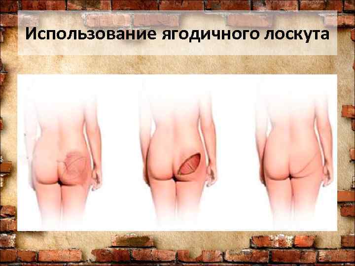 Использование ягодичного лоскута 