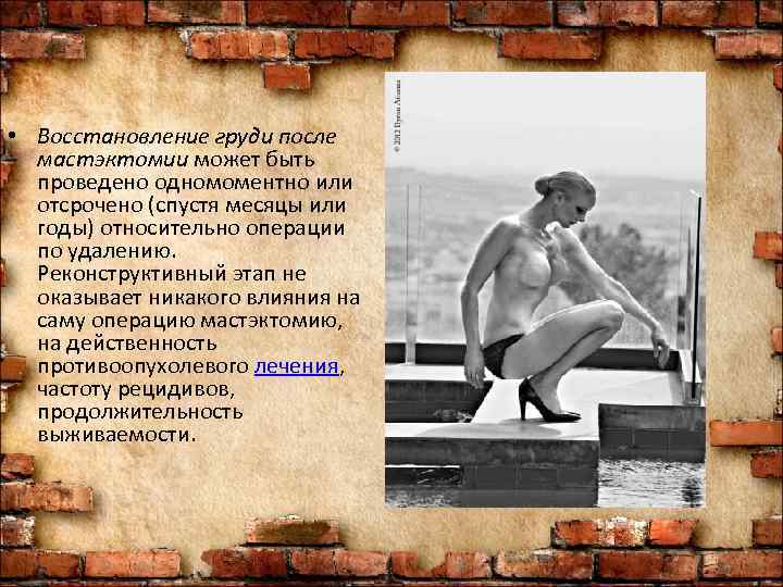  • Восстановление груди после  мастэктомии может быть проведено одномоментно или  отсрочено